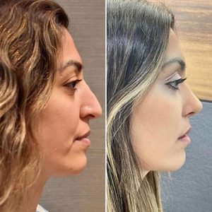 rhinoplastie corrigeant la bosse et remontant la pointe Tunisie prix