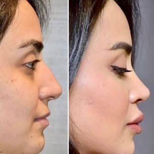 rhinoplastie corrigeant la bosse et remontant la pointe Tunisie avis